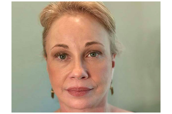 facelift necklift forehead lift after