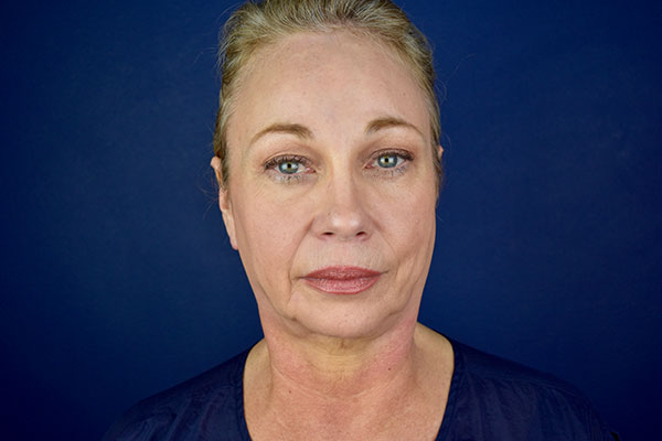 facelift necklift forehead lift before