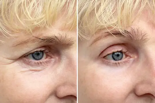 brow lift