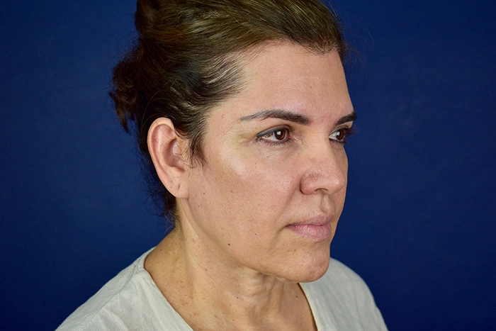 lEONELA ANTES FACELIFT7